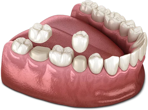 dental crown model