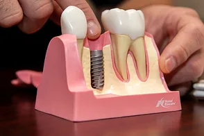 dental-implant-model