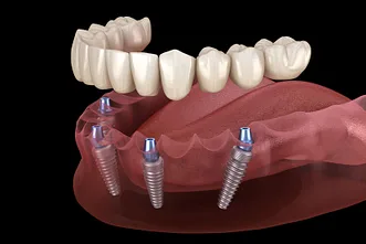 full mouth dental implants model