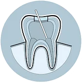 root canal process 4