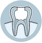 root canal process 5