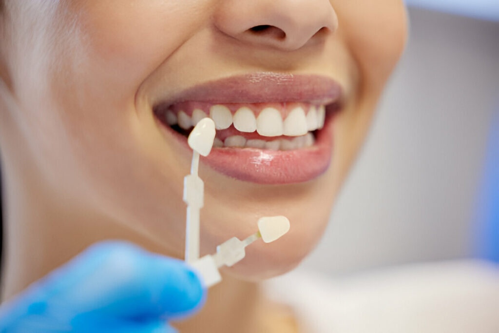 The Ultimate Guide to Dental Veneers: What to Expect from Your Dentist in Mississippi at Rowan Family Dentistry_1
