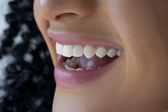 The Ultimate Guide to Dental Veneers: What to Expect from Your Dentist in Mississippi at Rowan Family Dentistry_FI