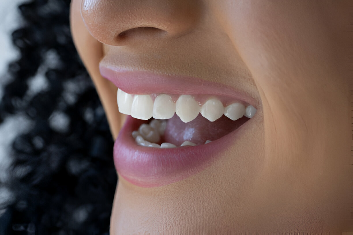 The Ultimate Guide to Dental Veneers: What to Expect from Your Dentist in Mississippi at Rowan Family Dentistry_FI