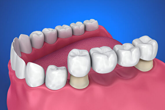 Caring for Your Dental Crowns Maintenance Tips for Long-Lasting Results