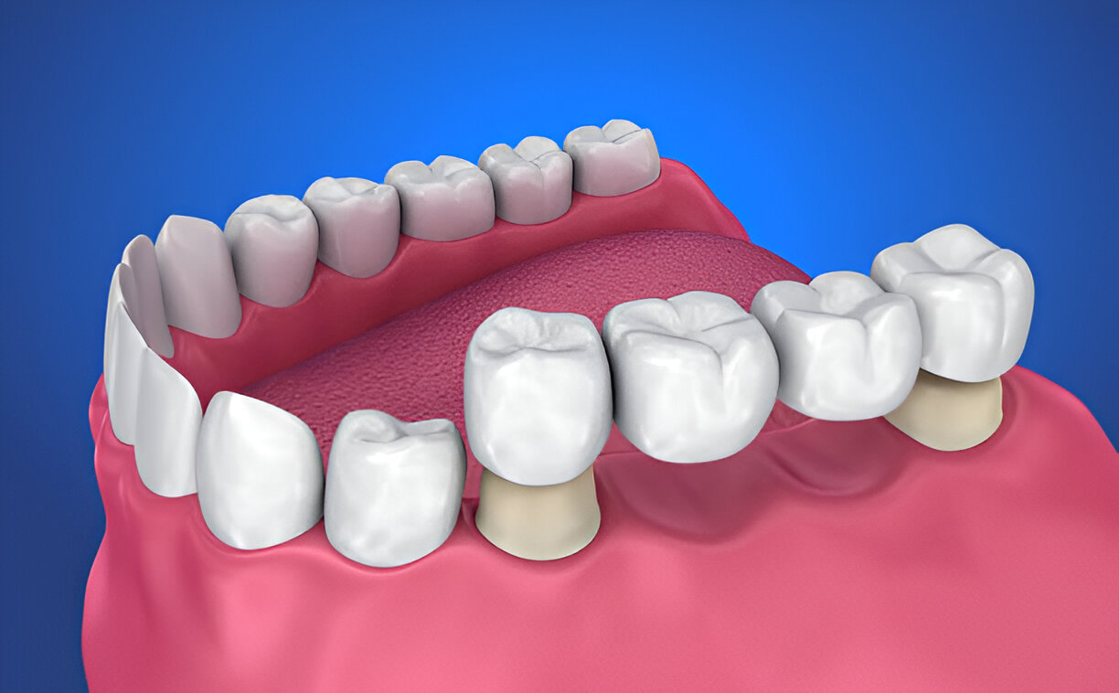Caring for Your Dental Crowns Maintenance Tips for Long-Lasting Results