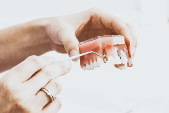 Aftercare for Single Dental Implants | New Albany, MS | Rowan Family Dentistry